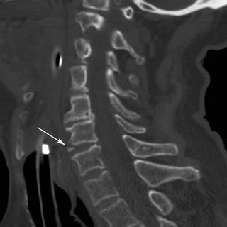 (PDF) Imaging of Cervicothoracic Junction Trauma