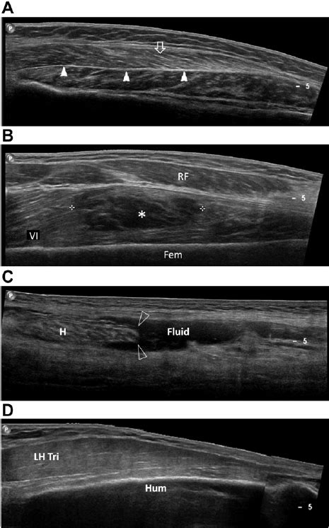 Ultrasound Pictures From Various Pathologies Of The Muscles A Normal
