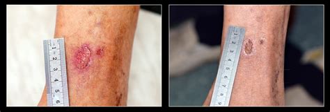 Chronic Wound Healing Linline Medical Systems