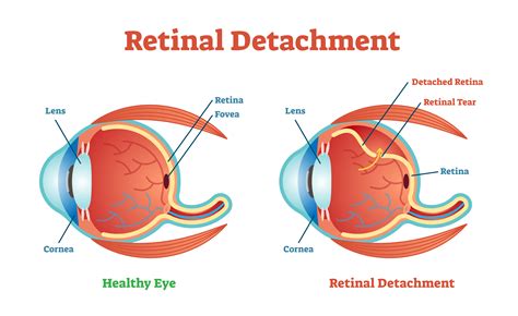 Retinal Detachment Causes How To Get Treatment NVISION Eye Centers