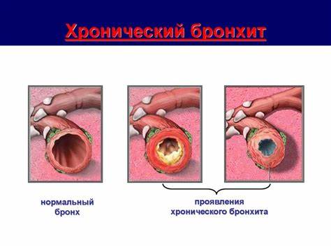 Хронический бронхит и диеты Бронхит острый, хронический - презентация онлайн Бронхит острый, хронический - презентация онлайн Хронический бронхит и диеты