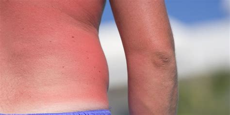 How Long It Really Takes For A Sunburn To Heal