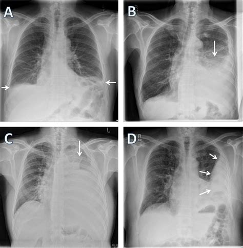 The Modern Diagnosis And Management Of Pleural Effusions The Bmj
