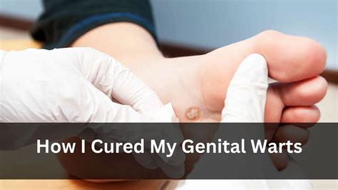 How I Cured My Genital Warts A Personal Journey To Overcoming A Common