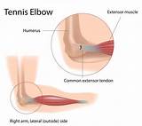 Tendonitis Therapy