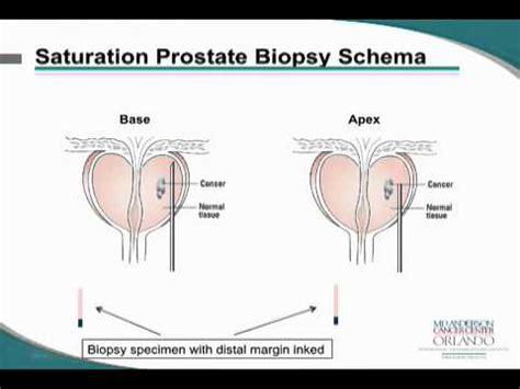 Prostate Cancer Focal Cryoablation Treatment YouTube