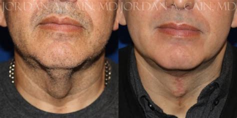 57 Year Old Man Treated With Direct Neck Lift Pic With Dr Cain Frisco