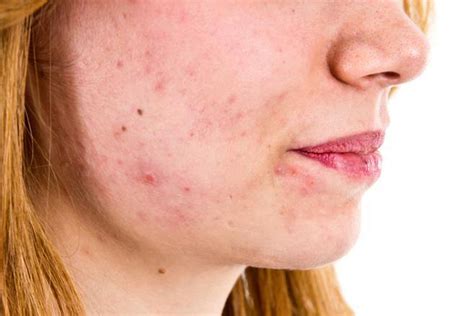 Acne Bacteria Does It Really Cause Acne Health News