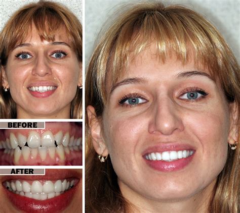 Bonding Teeth Before And After Teethwalls