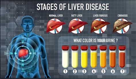 Liver Cancer Types And Stages