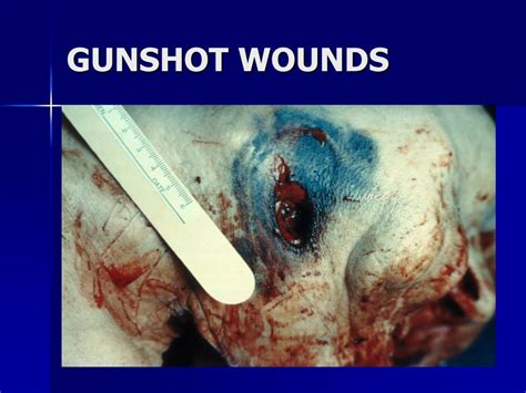 Intermediate range gunshot wound, gross; PPT - FORENSIC PATHOLOGY PowerPoint Presentation, free download - ID:3566989