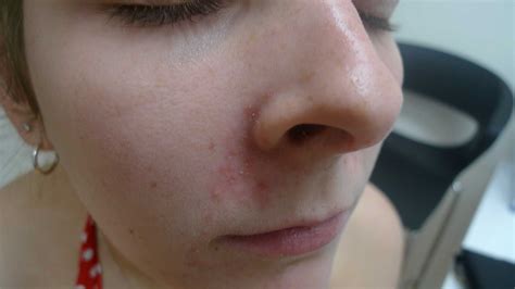 Dermatitis Nose Causes Symptoms And Treatments