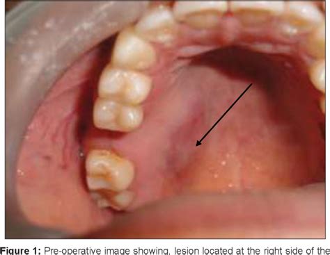Figure 1 From Mucoepidermoid Carcinoma Of Palate A Case Report