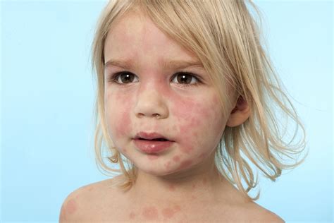 Child Has Rash On Face And Neck Preventive Medicine