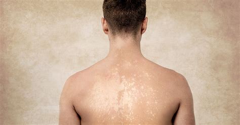10 Natural Remedies For Tinea Versicolor You Can Get At Home