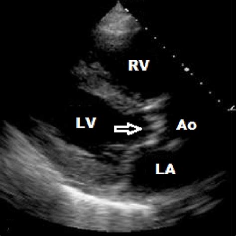 Echo Assessment Of Aortic Stenosis Hot Sex Picture