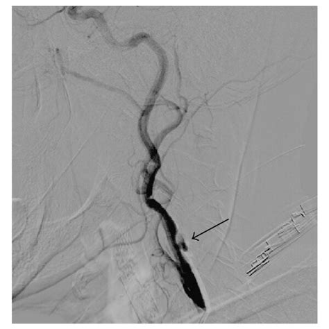 Aortic Arch Angiogram Revealed Critical Stenosis In The Proximal Right