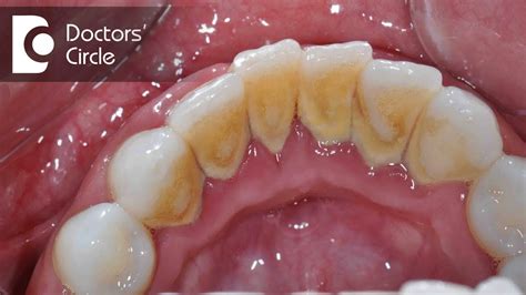 Hard Calcium Deposits On Teeth Teethwalls