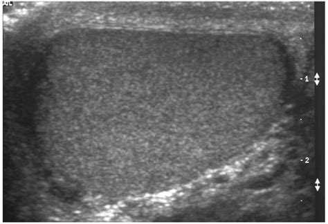 Testicular cancer is a disease that occurs when cancerous (malignant) cells develop in the tissues of a tests to help diagnose testicular cancer can include: Testicular Cancer | Urology Surgeon