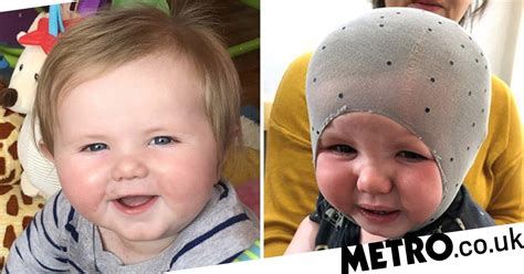 Boy Born With ‘flat Head Syndrome Wears Helmet 23 Hours A Day Metro News