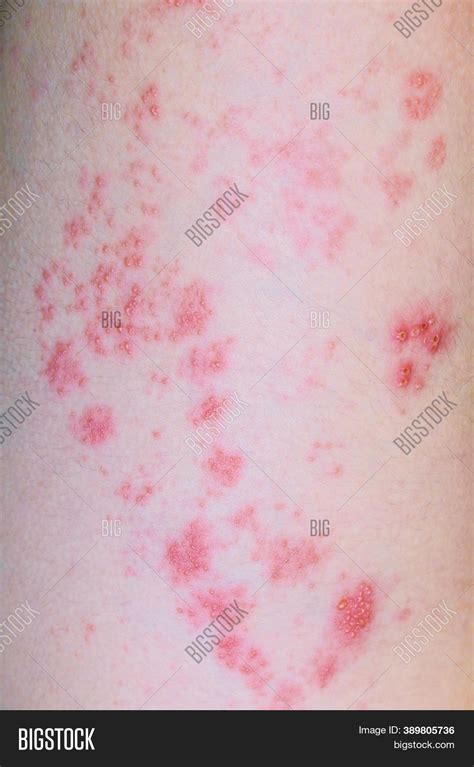 Rash Blisters Viral Image And Photo Free Trial Bigstock