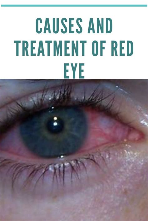 Redness Of The Eye Red Eye Causes Swollen Eyes Eye Heal