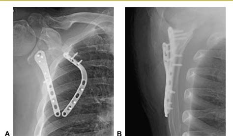 Figure 3 From Dorsal Plate Fixation Of Scapular Fracture Semantic