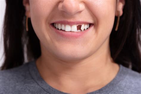 Missing Teeth Easy Solutions For A Beautiful Smile