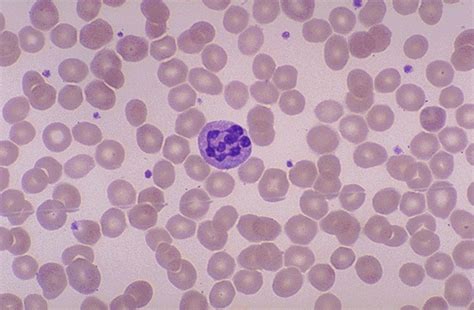Hypersegmented Neutrophil With Megaloblastic Anemia On Smear Medical