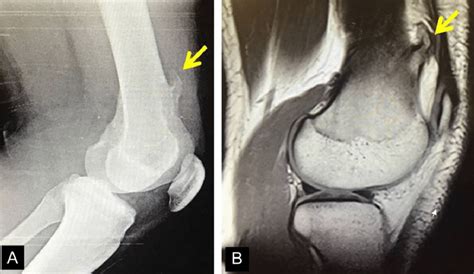 (A) X-ray of the exostosis in the second patient, (B) MRI depicts the ...