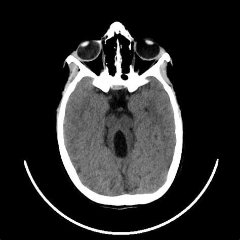 Joubert Syndrome Radiology Case Radiology Brain