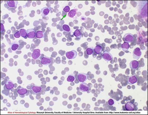 B Cell Prolymphocytic Leukaemia Cell Atlas Of Haematological Cytology