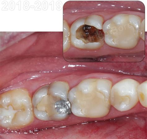Dente Encavalado Antes E Depois Coloca O Das Lentes De Contato Dental