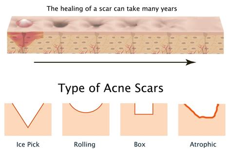 Acne Scars Treatment Clinique Spécialisée à Hull Gatineau Ottawa