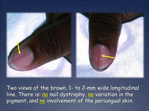 A Long Brown Line Under A Young Womans Fingernail Patient Care Online