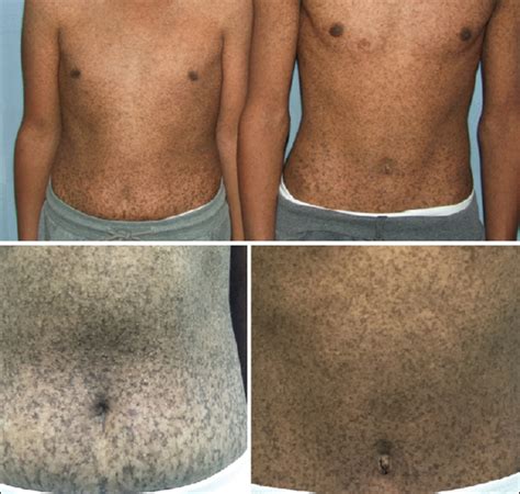 Two allelic ectodermal dysplasias caused by dominant. Indian Journal of Dermatology: Table of Contents