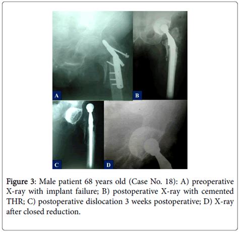 Orthopedic Muscular System Male Patient Cemented Thr