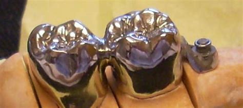 Prothèse conjointe couronne métallique Lens Prothèses dentaires Douai