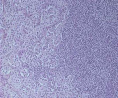 A Metastasis Of Acinaradenocarcinoma Into A Regional Lymph Node