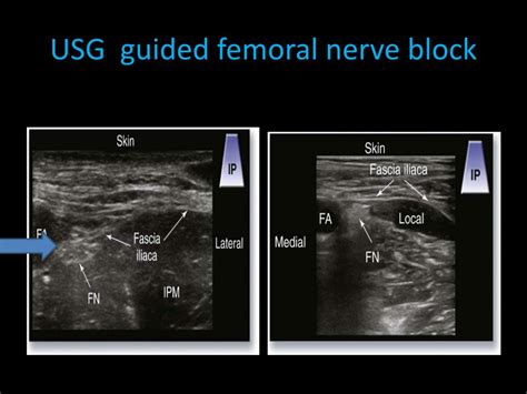 Ppt Femoral Nerve Block Powerpoint Presentation Free Download Id