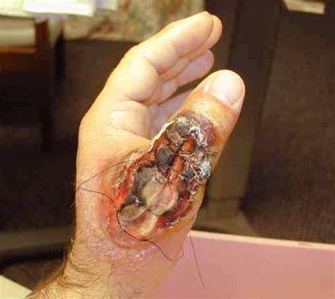 Camel Spider Bite Pictures Facts First Aid And Treatment 2018