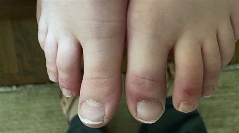 Pediatricians Warned About Covid Toes In Children Infected With Covid