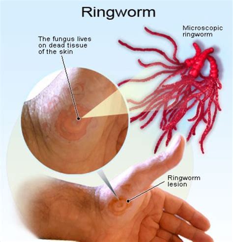 Yeast Infection Dead Skin Guide