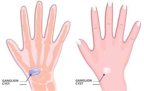Ganglion Cyst Of The Wrist How Do I Know If I Have One