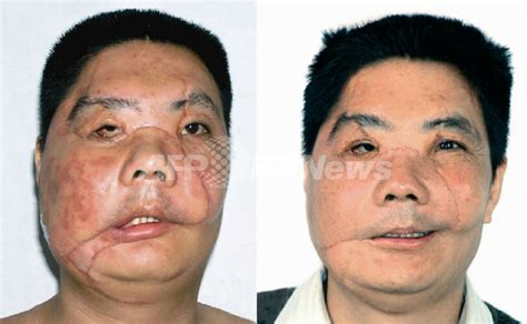 顔面移植、「顔面変形」の有効な治療法として期待 写真5枚 国際ニュース：afpbb News
