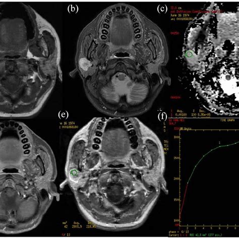 Metaplastic Warthins Tumor Of The Left Parotid Gland In A 81 Year Old