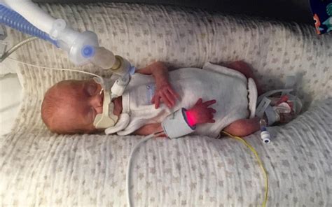 Miracle Baby Born At Just 22 Weeks And Weighed Only 1lb 4oz