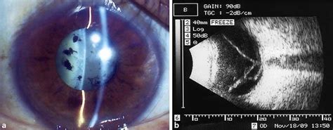 Preoperative Clinical Findings A Slit Lamp Examination Revealed The
