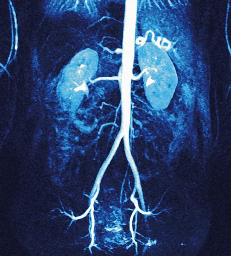 Normal Renal Arteries Mra Scan Photograph By Miriam Maslo