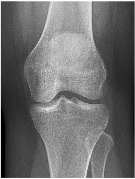 X Knee Startradiology Knee Joint Radiology Imaging Avulsion Fracture